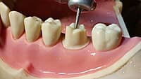 API Typodont Teeth Set with Screw