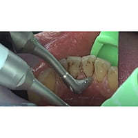 NSK Prophy-Mate neo Dental Air Polisher