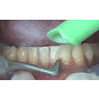 NSK Prophy-Mate neo Dental Air Polisher