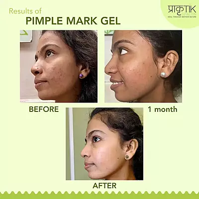 Tarunya Pitaka Pimple Mark gel
