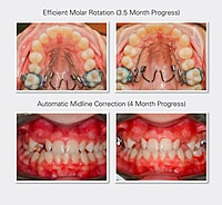 Ortho Organizers Nitanium Palatal Expander 2 Appliance