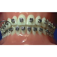 Phyx Streak Metal Self-Ligating Brackets