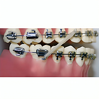 U Ortho Bondable Buccal Tubes – 1st Molar MBT 0.022 – U1/L1