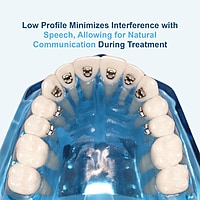 U Ortho Lingual Brackets 018 – STB, Silver & Golden Series